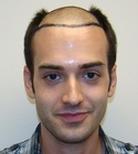 Hair Transplant Images 