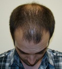 Hair Transplant Images 