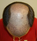 Hair Transplant Images 