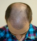 Hair Transplant Images 