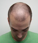 Hair Transplant Images 