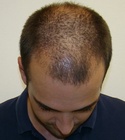 Hair Transplant Images 