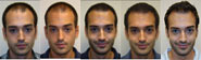 Hair Transplant Stages