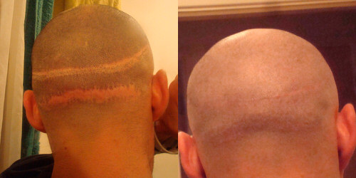 hair transplant Scar Repair photos