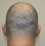 Hair Transplant Fue Scar