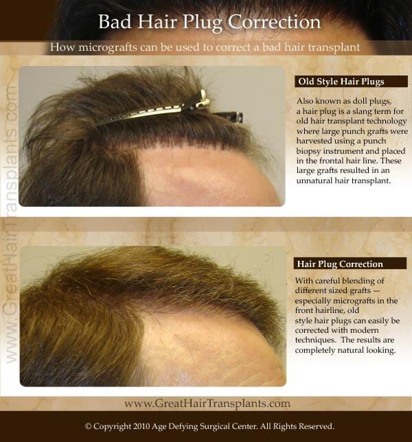 bad hair plugs