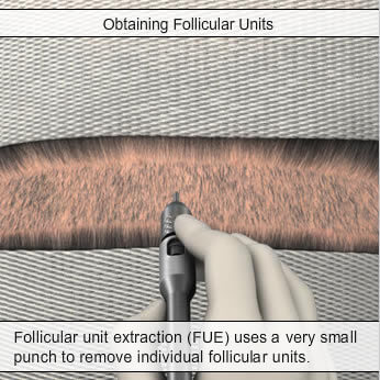 Follicular Unit Extraction (FUE) Neograft Doctors / Human Hairline