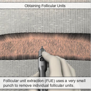 FUE Hair Transplant