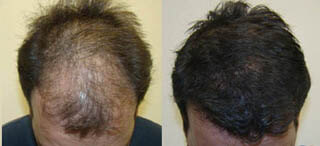 hair transplant results