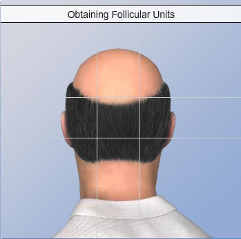 Animation about Hair Transplants
