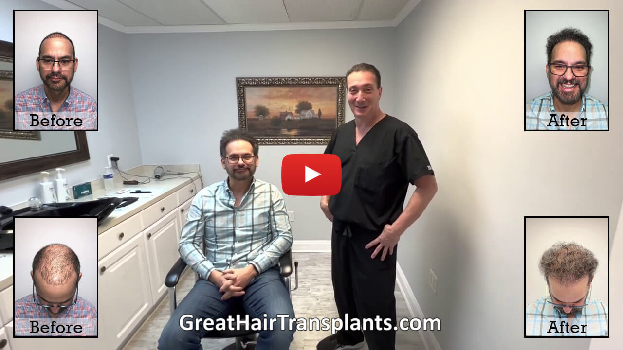 Must Watch Video for Patients Seeking a FUE / Failed FUE Turkey / correction by Dr. Brett Bolton