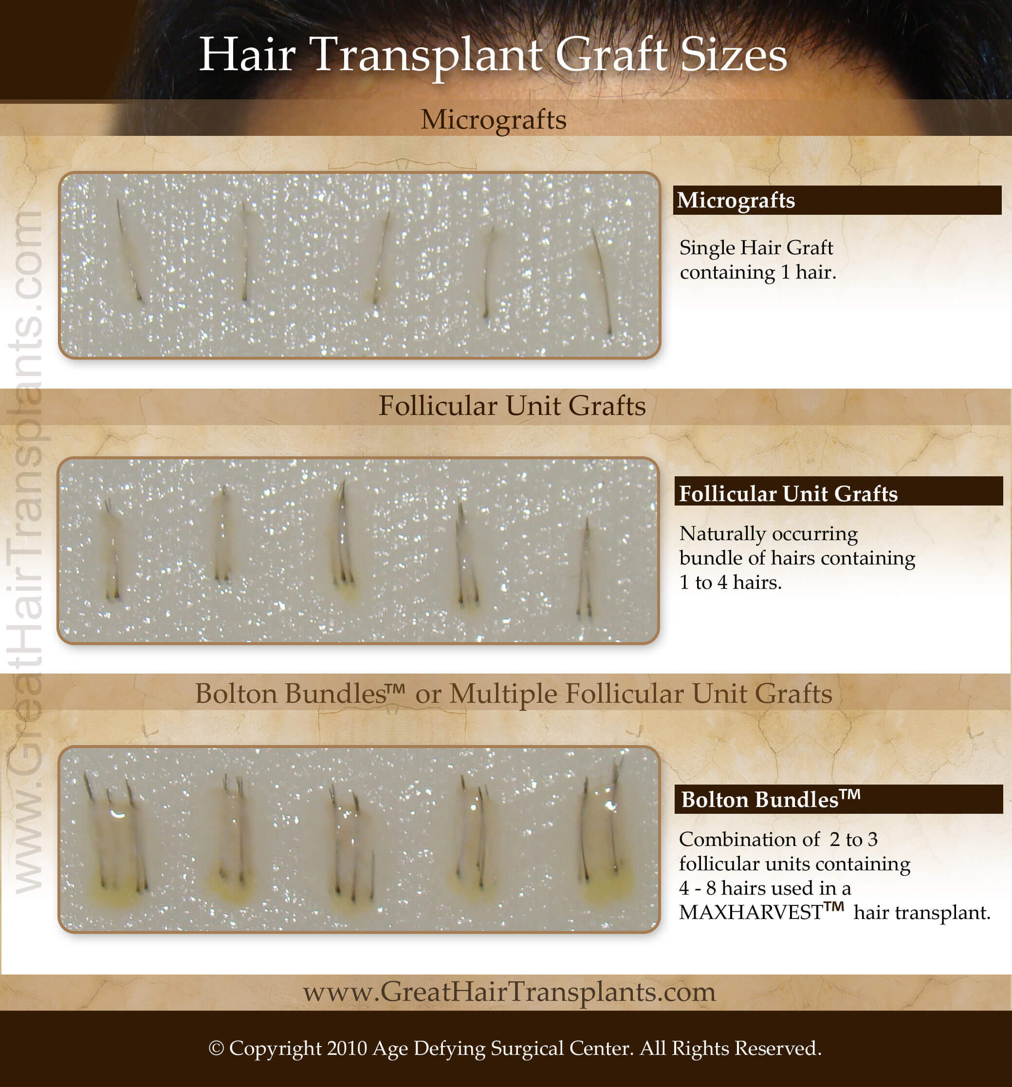 hair graft sizes