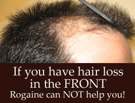 what happens if i use rogaine for frontal baldness