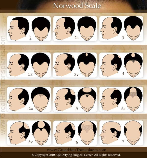 Norwood Chart Pattern Baldness