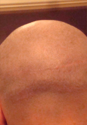 hair transplant photos