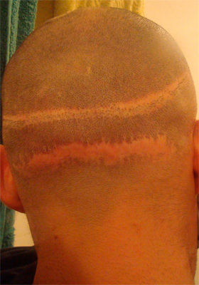 hair transplant photos