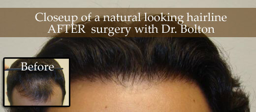 natural looking hair transplant