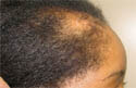 traction alopecia