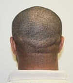 Dr. Brett Bolton Hair Transplant  Suture lines