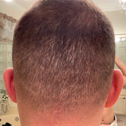 Hair Transplant Fue Scar 