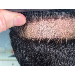 Hair Transplant Fue Scar 