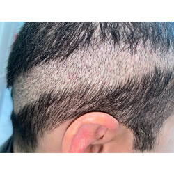 Hair Transplant Fue Scar 