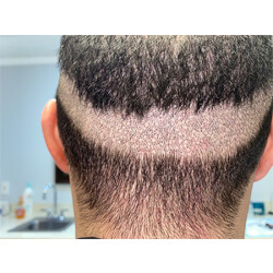 Hair Transplant Fue Scar 