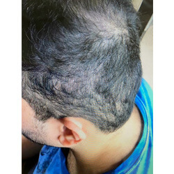 Hair Transplant Fue Scar 