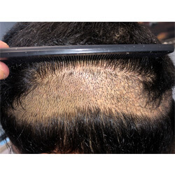 Hair Transplant Fue Scar 