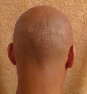 Hair Transplant Fue Scar Maxharvest Correction