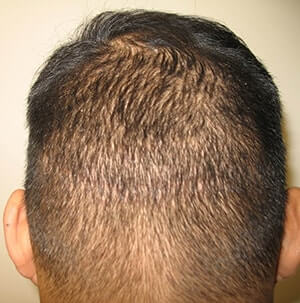 Dr. Brett Bolton Hair Transplant  Suture lines