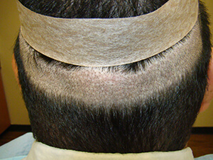 Hair Transplant Fue Scar 