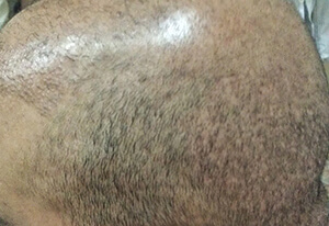 Hair Transplant Fue Scar 