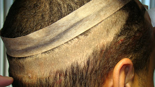 Hair Transplant Fue Scar 