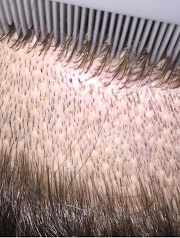 Hair Transplant Fue Scar 