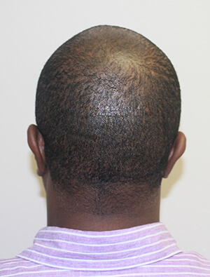 Dr. Brett Bolton Hair Transplant  Suture lines