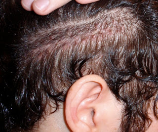 Hair Transplant Fue Scar