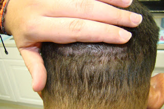 Dr. Brett Bolton Hair Transplant  Suture lines