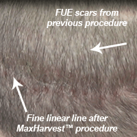 Hair Transplant Fue Scar