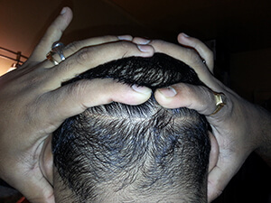 Dr. Brett Bolton Hair Transplant  Suture lines