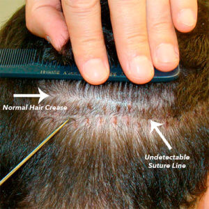 Dr. Brett Bolton Hair Transplant  Suture lines