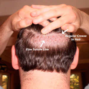 Dr. Brett Bolton Hair Transplant  Suture lines