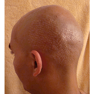 Hair Transplant Fue Scar