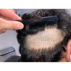 Hair Transplant Fue Scar 