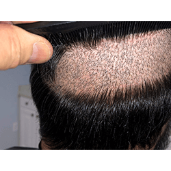 Hair Transplant Fue Scar 