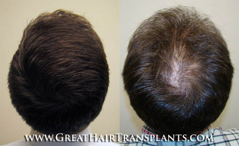 hair transplants cost