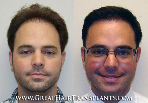 low cost hair transplants