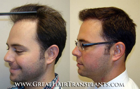 affordable hair transplants