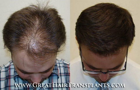 hair restoration