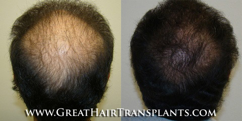 hair transplants cost